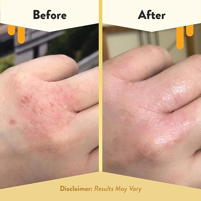 Eczema Honey Original Skin-Soothing Cream